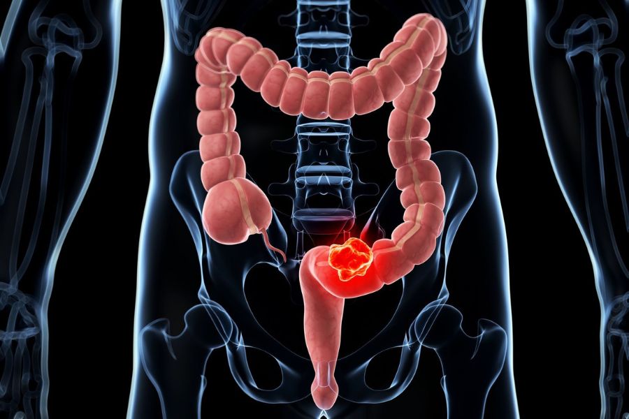 drmasoumi-Colon-cancer-03-min