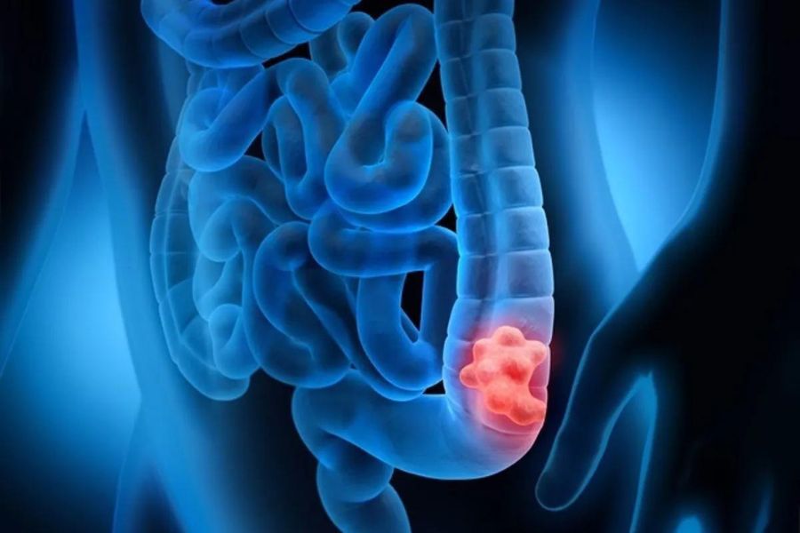 drmasoumi-Colon-cancer-04-min