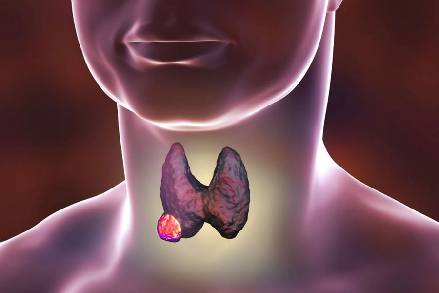 drghasemmasoumi-thyroid-diseases-07